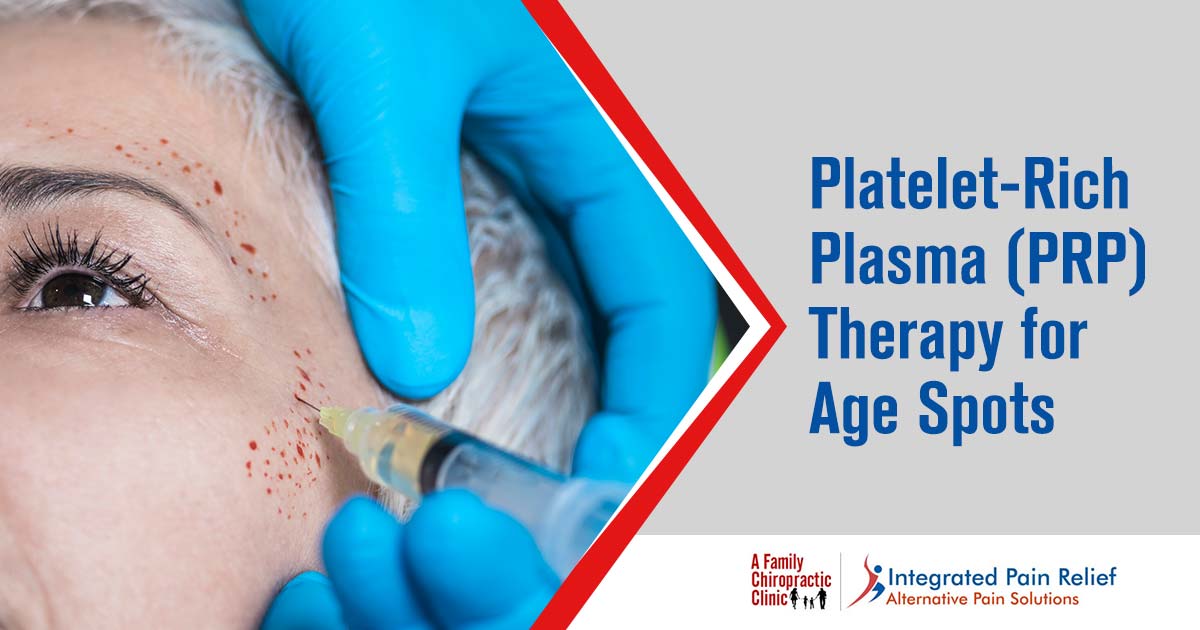 Platelet-rich plasma (PRP) Therapy for Age Spots