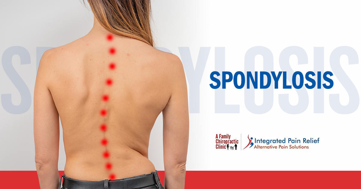 Spondylosis
