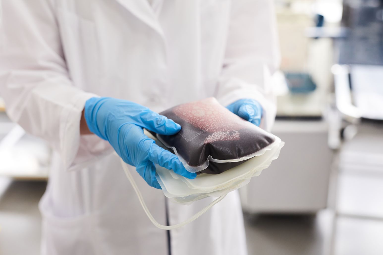 What Is Platelet-Rich Plasma Image of plasma sample, featuring A Family Chiropractic Clinic and highlighting the benefits and explanation of Platelet-Rich Plasma (PRP) therapy.